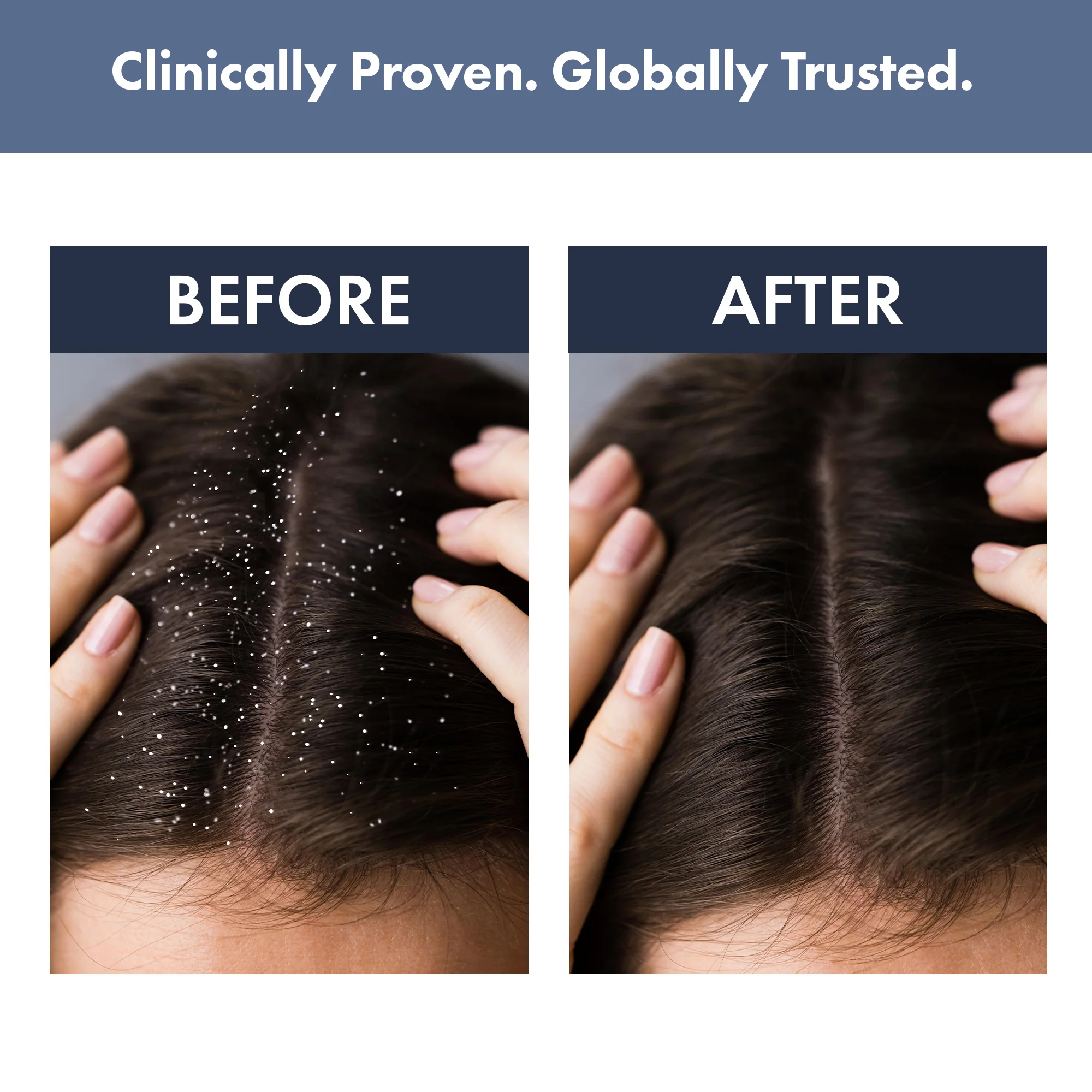Anti-dandruff kit: Scalp Clear Shampoo + Anti Dandruff Serum - Image 5