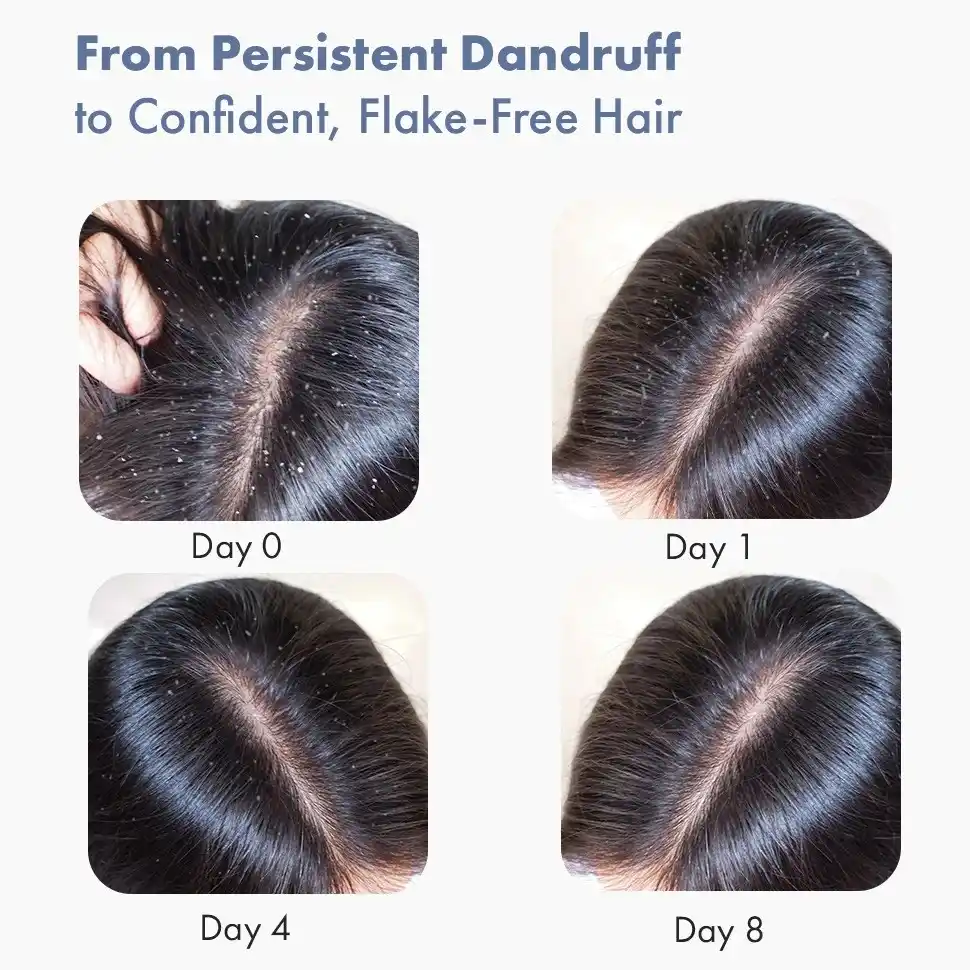 Anti Dandruff Serum, 10ml - Image 10