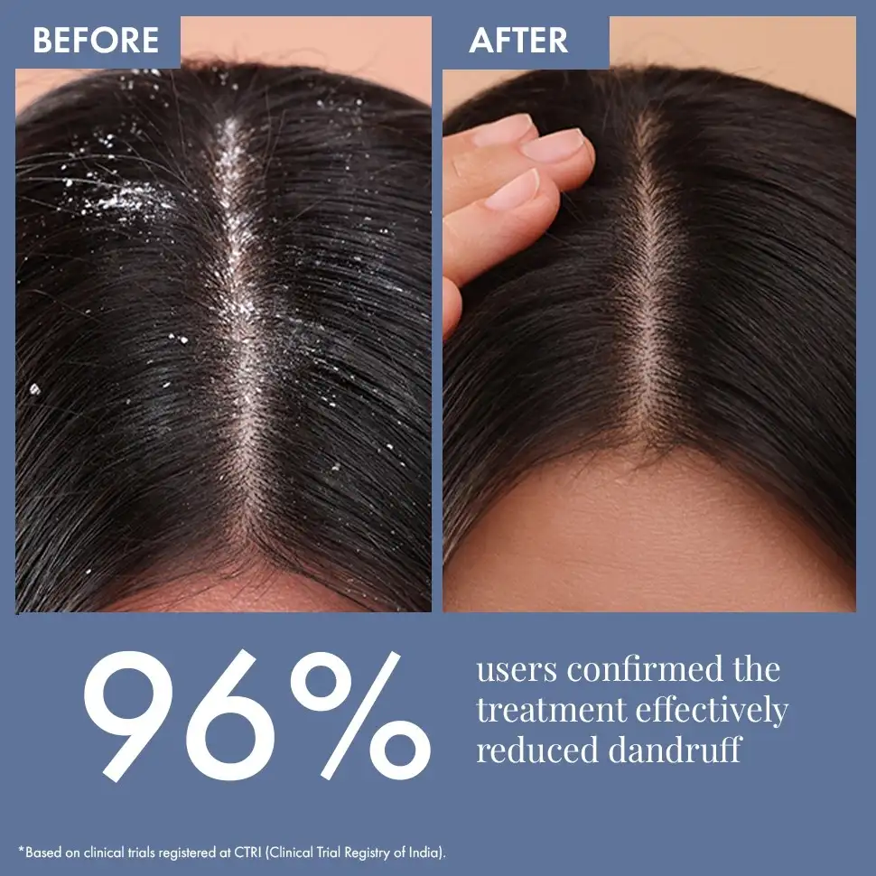Anti Dandruff Serum, 10ml - Image 4