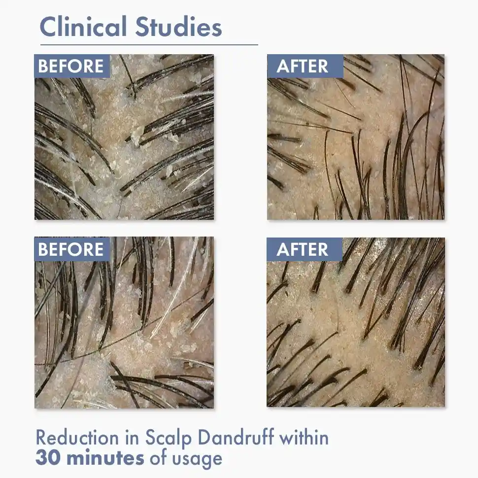 Anti Dandruff Serum, 10ml - Image 5