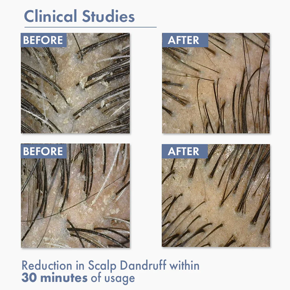 Anti Dandruff Serum, 10ml - Image 5