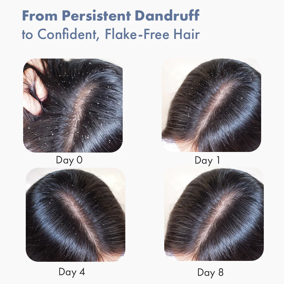 Anti Dandruff Serum, 10ml - Image 9
