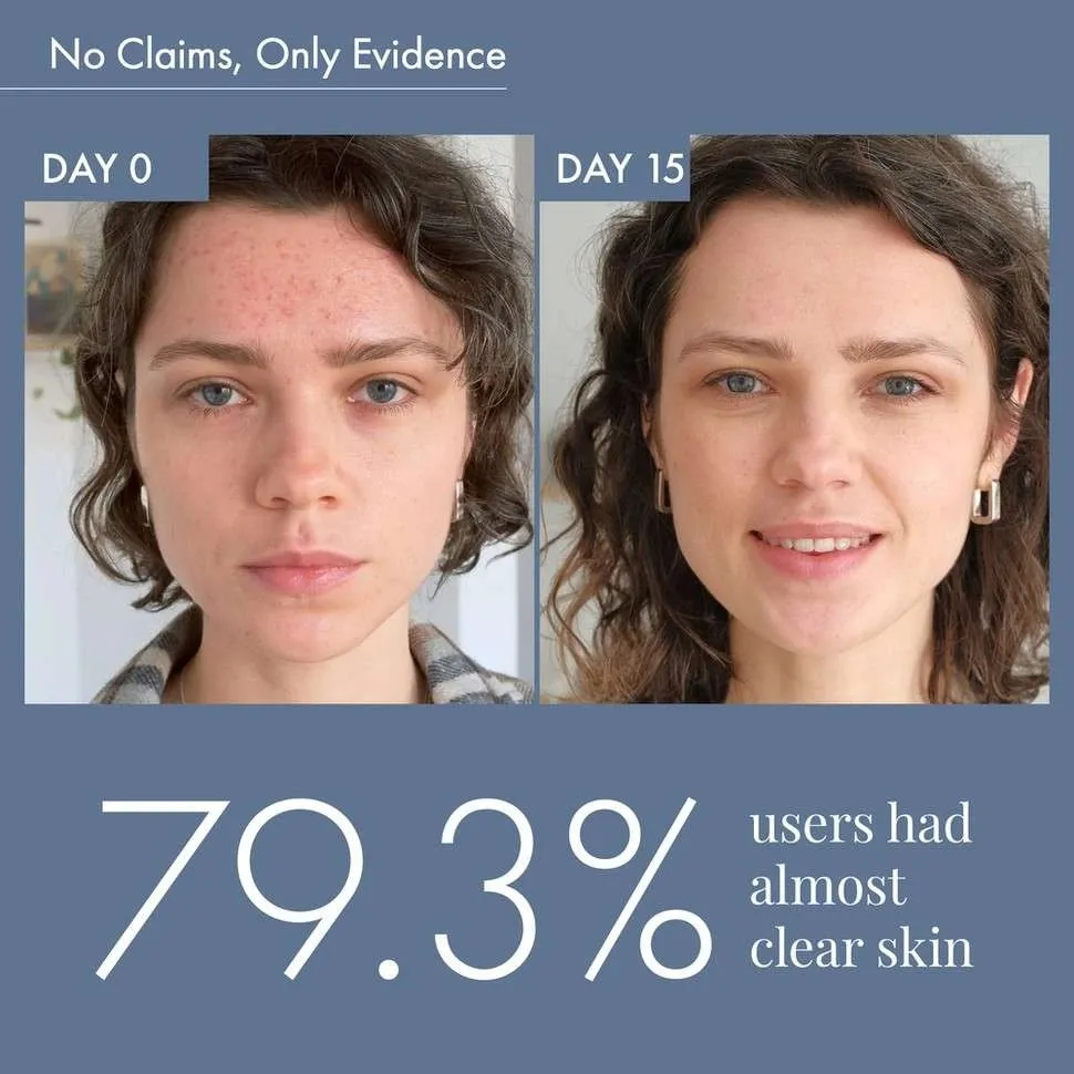 Goodbye Acne Cleanser & Acne Serum - Image 8