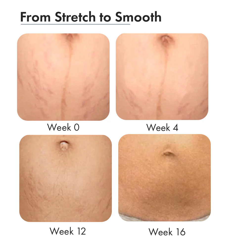 Stretch Marks Trial Kit - Image 5