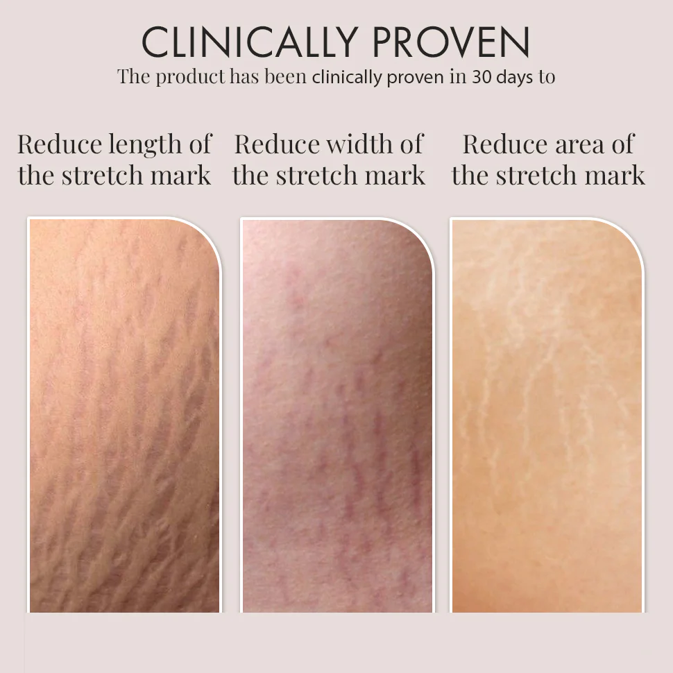 Stretch Marks Trial Kit - Image 7